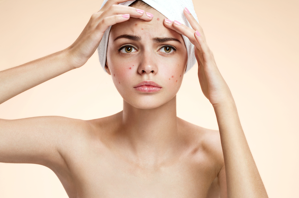 curare acne con omega 3