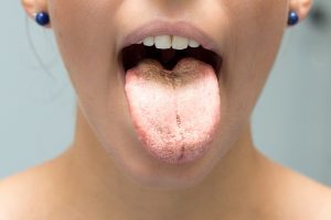 Candida: cos’è, tipologie, cause, sintomi, cure e prevenzione