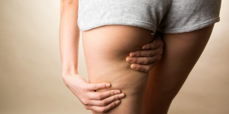 primo piano delle gambe di una donna con shorts grigio che esegue con le mani un massaggio anticellulite per drenare le gambe