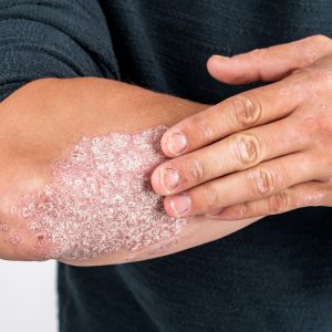 Psoriasi Sintomi Diagnosi E Cura Per Questa Patologia Melarossa