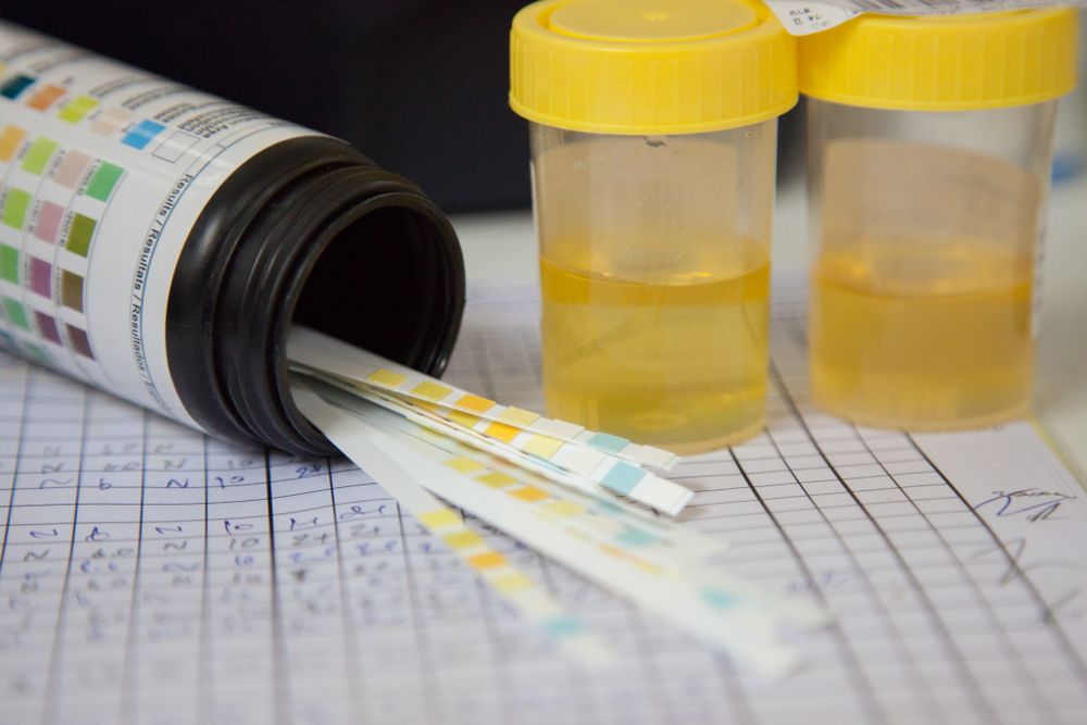 Esame delle urine per il diabete