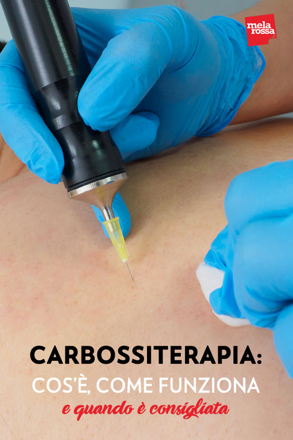 La carbossiterapia: un trattamento “vecchio” che, in barba all’età, combatte i segni del tempo e gli inestetismi della pelle più odiati. Nasce negli anni ’30, in Francia, per contrastare i disturbi vascolari, e non è ancora andata in pensione, anzi! Melarossa.it #dietamelarossa