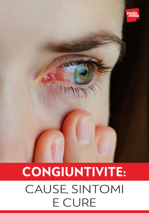 La congiuntivite è un’infiammazione della congiuntiva, il tessuto che ricopre la superficie interna delle palpebre e quella anteriore del bulbo oculare. La congiuntiva svolge la funzione di difendere l’occhio dai microrganismi e di proteggerlo da sostanze estranee: in condizioni di normalità viene lubrificata dalla secrezione emessa dalle ghiandole lacrimali. Melarossa.it #dietamelarossa