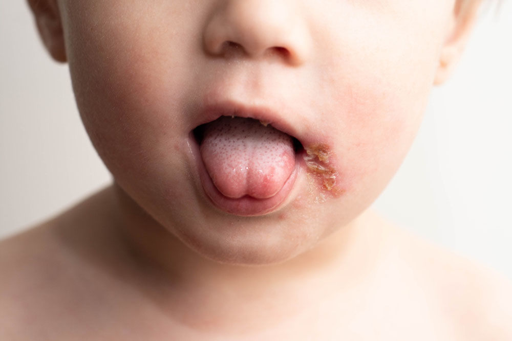 Herpes labiale nei bambini picoli