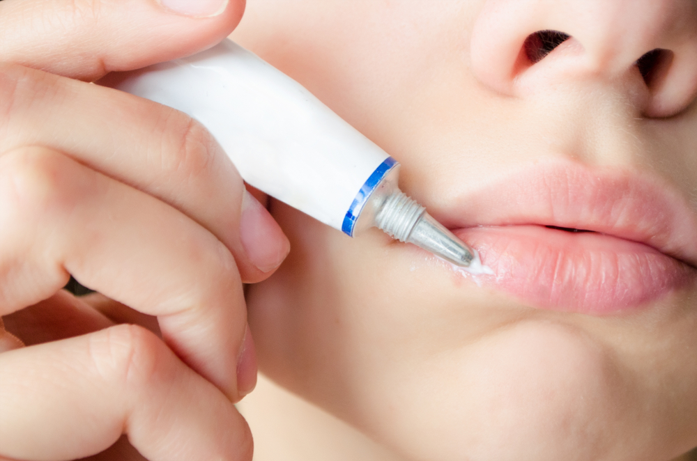 Come si cura l'herpes labiale