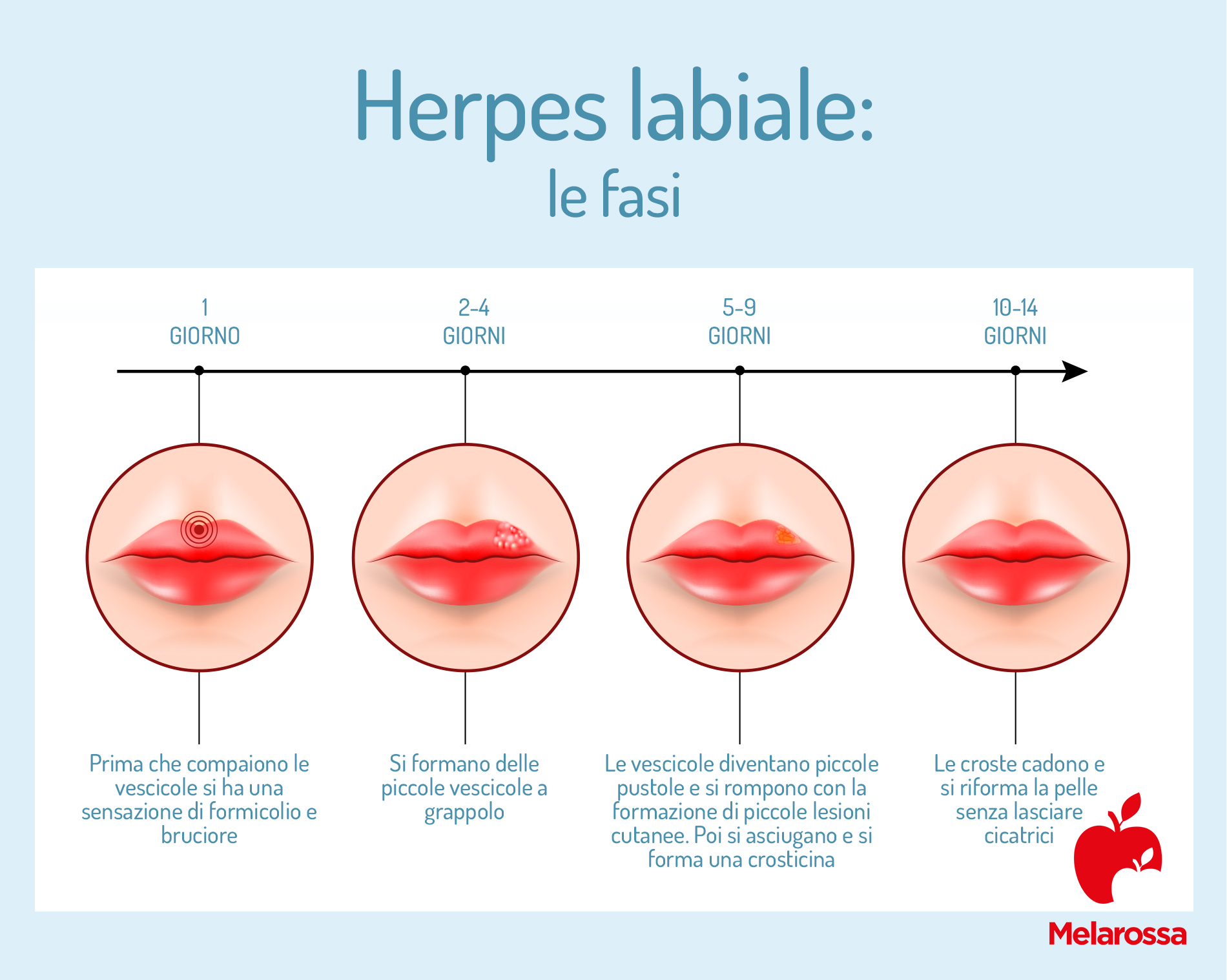 Le fasi dell'herpes labiale