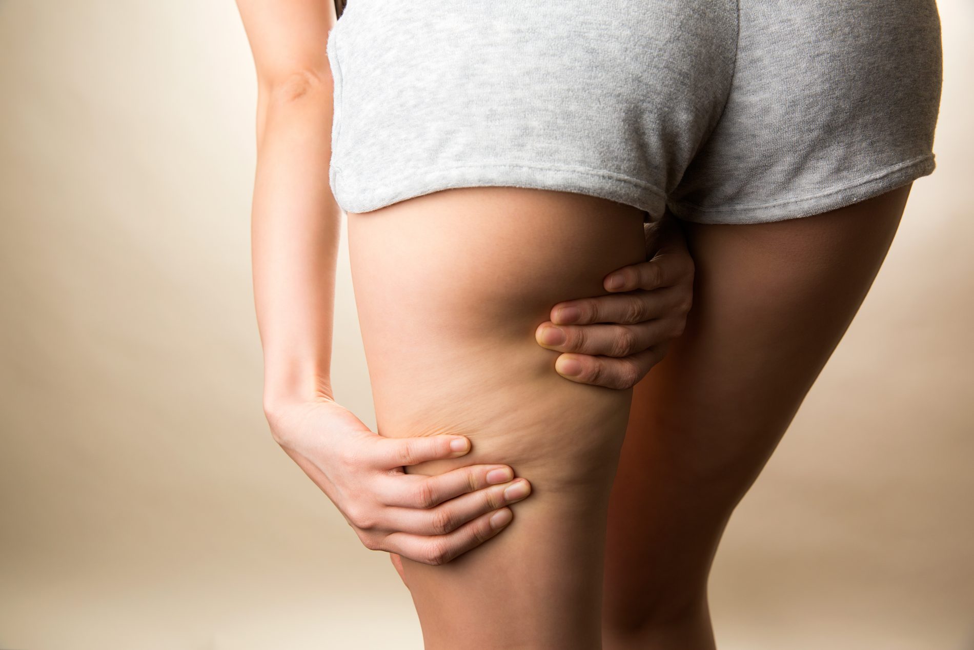 cellulite: cos'è, cause e rimedi