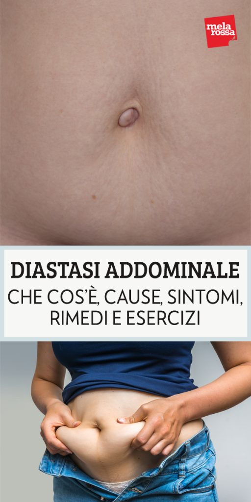 diastasi addominale cause e sintomi