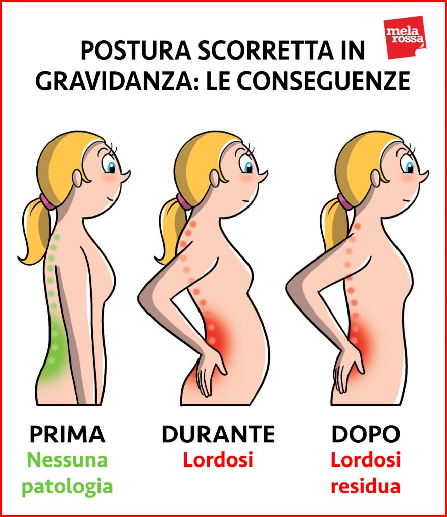 modifiche del corpo materno: postura e mal di schiena