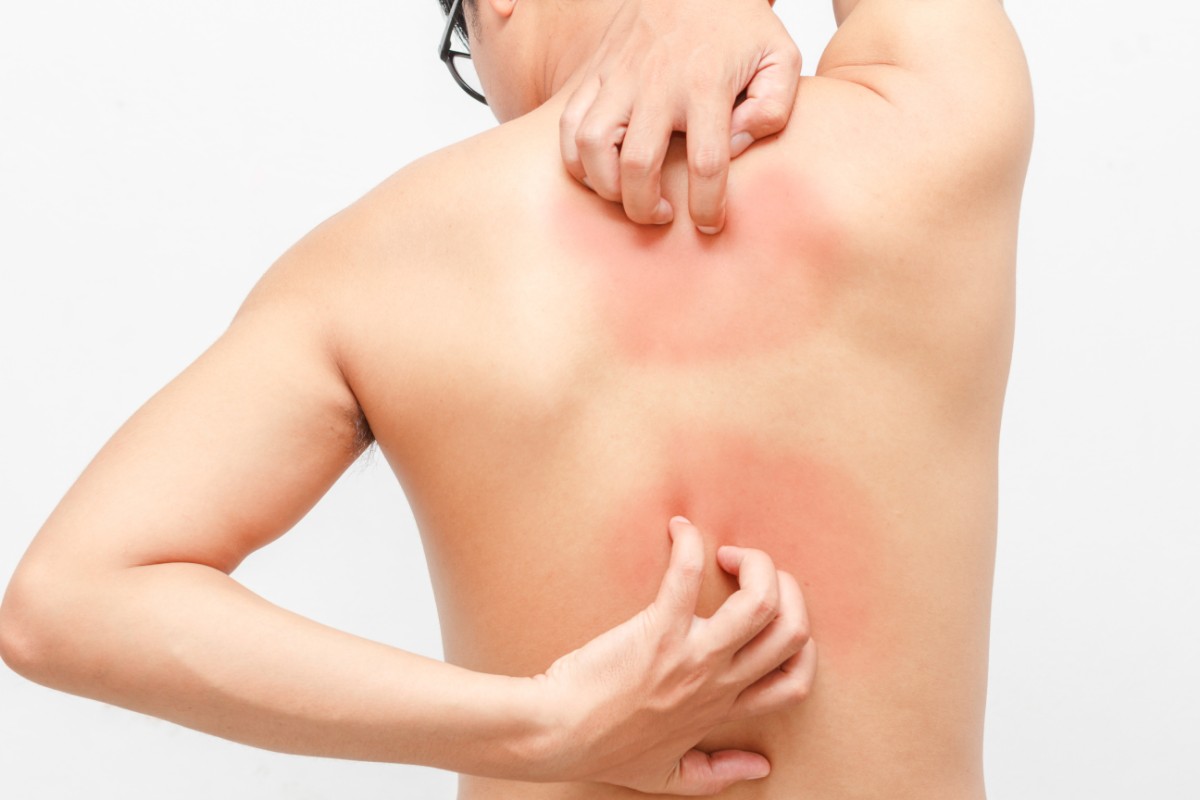 psoriasi: sintomi