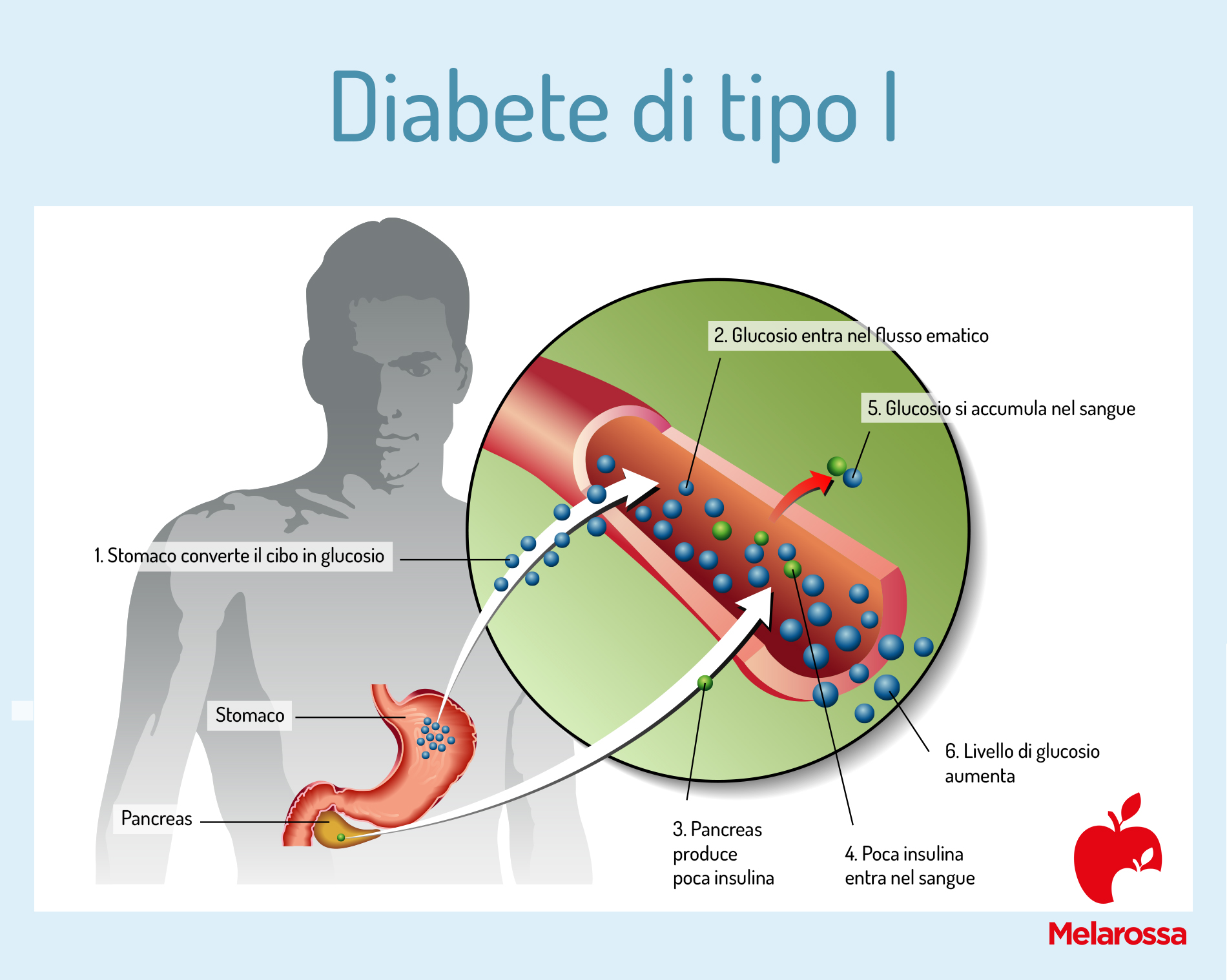 diabete di tipo 1