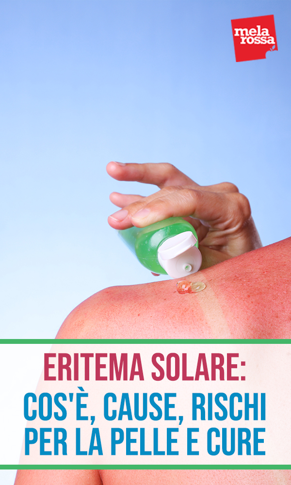 Eritema solare: cos'è, cause, rischi, cure