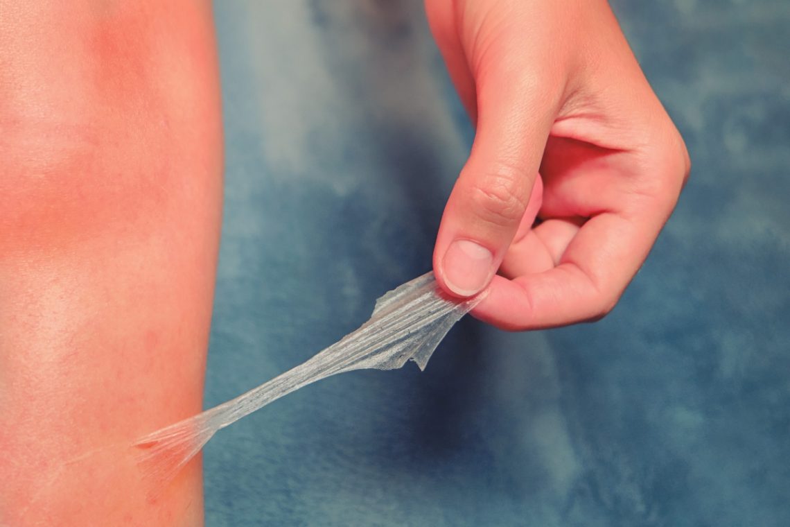 Eritema solare cos'è, cause, sintomi, rischi, cure e prevenzione