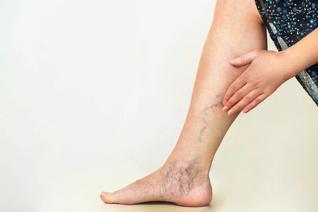 aumentare il metabolismo dieta reni gambe gonfie