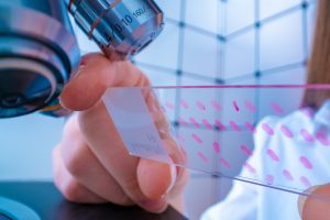 Scoperto il gene che nasconde cellule del cancro