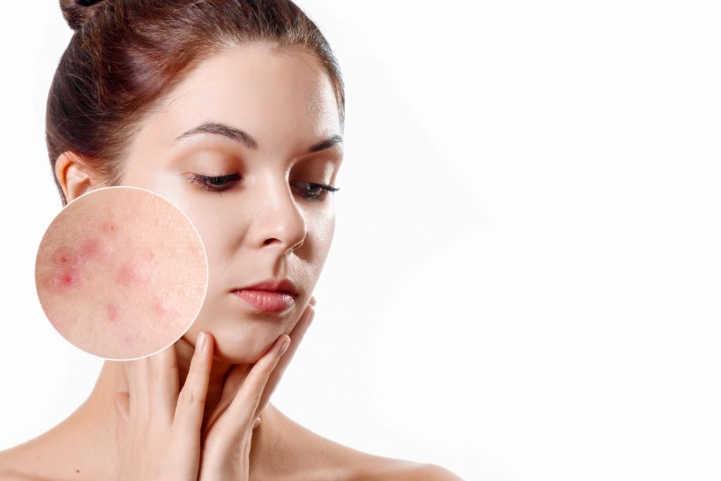 acne-viso