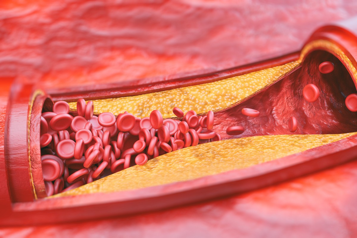 arteria patologie 