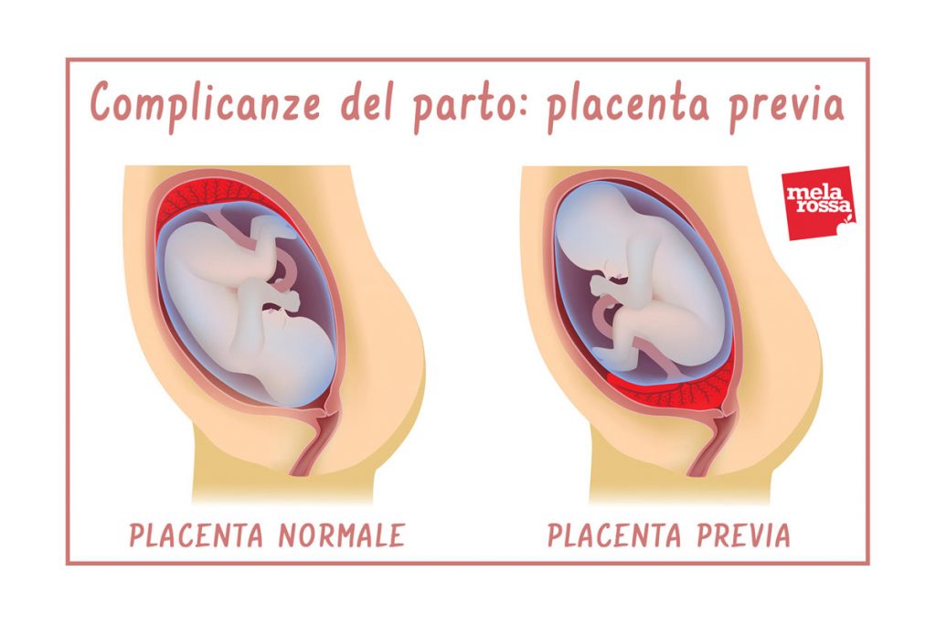 complicanze del parto: placenta previa