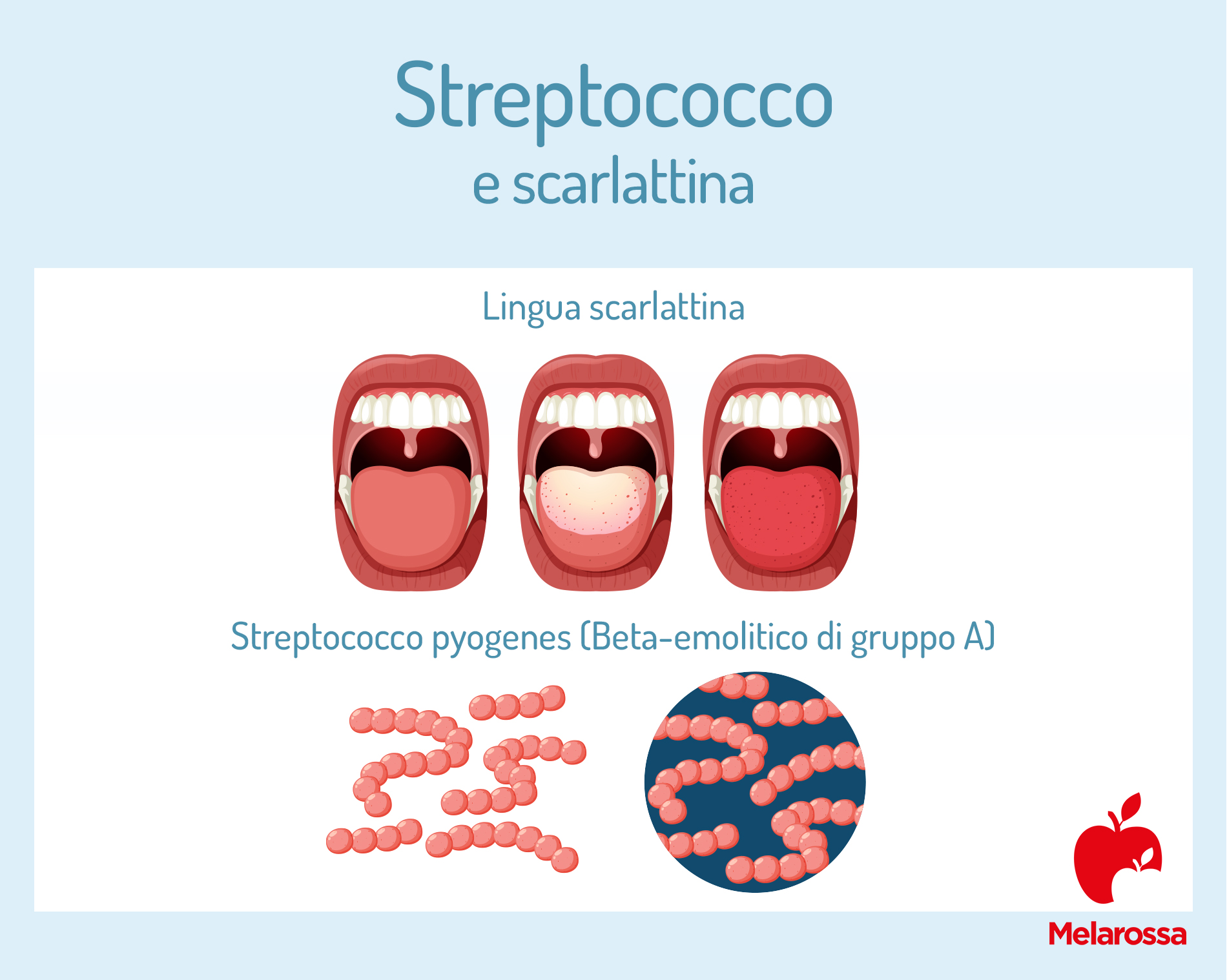 Streptococco e scarlattina