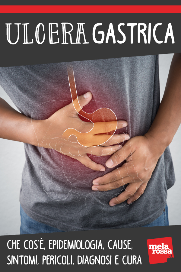 ulcera gastrica: che cos'è, sintomi, cause, diagnosi e cura