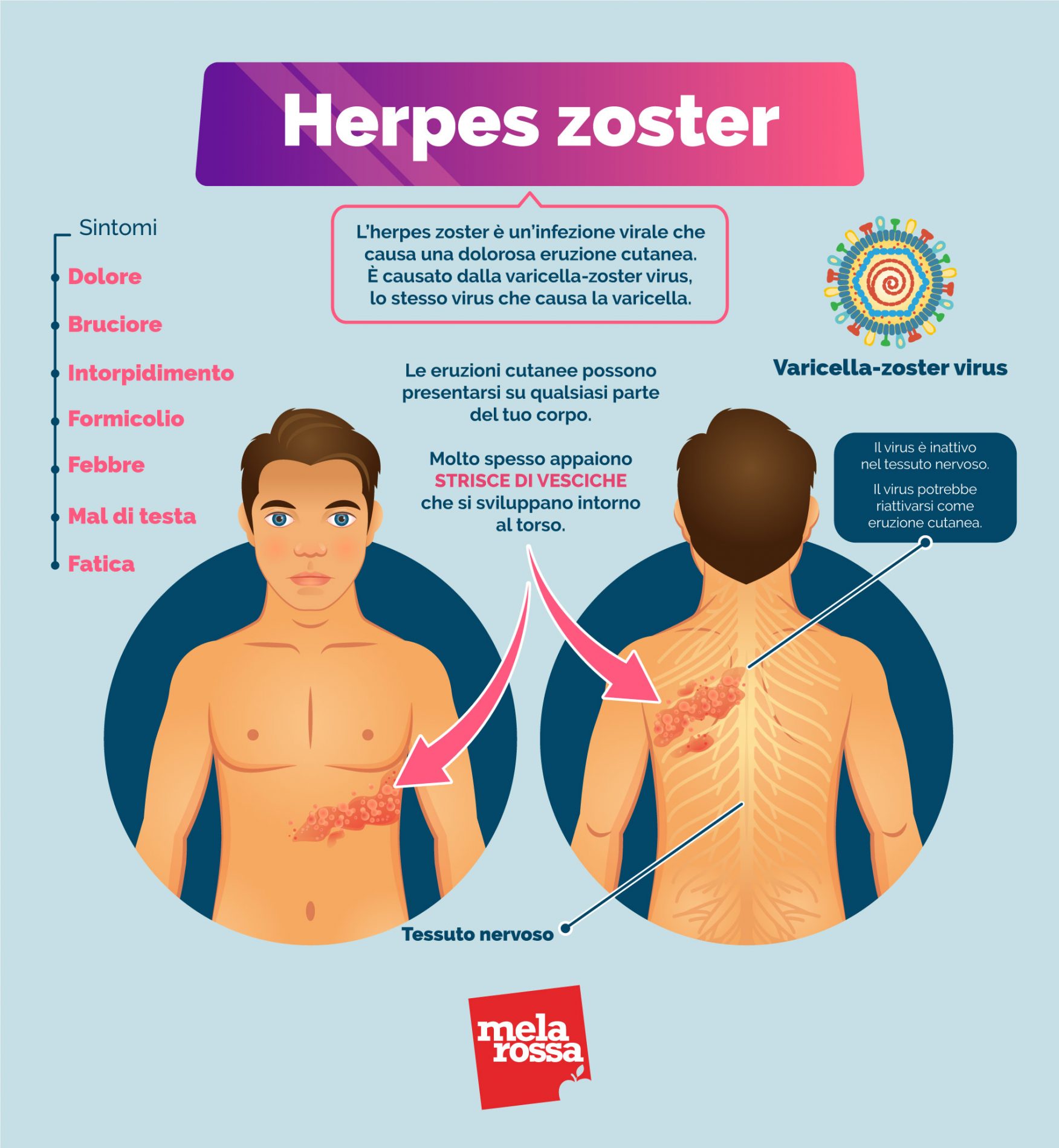 herpes zoster: sintomi
