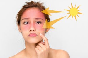 Come prevenire l’eritema solare: scegliere la crema in base al fototipo, integratori per la pelle e cibi
