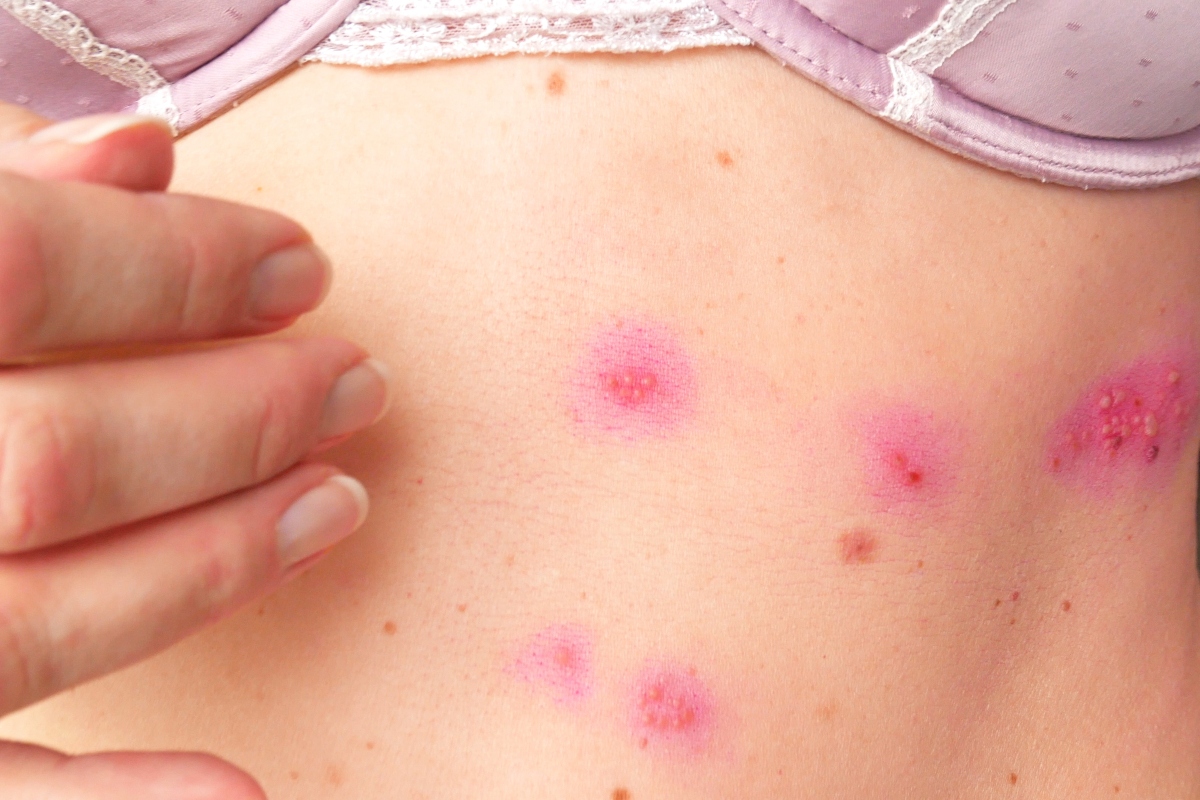 herpes zoster: cause