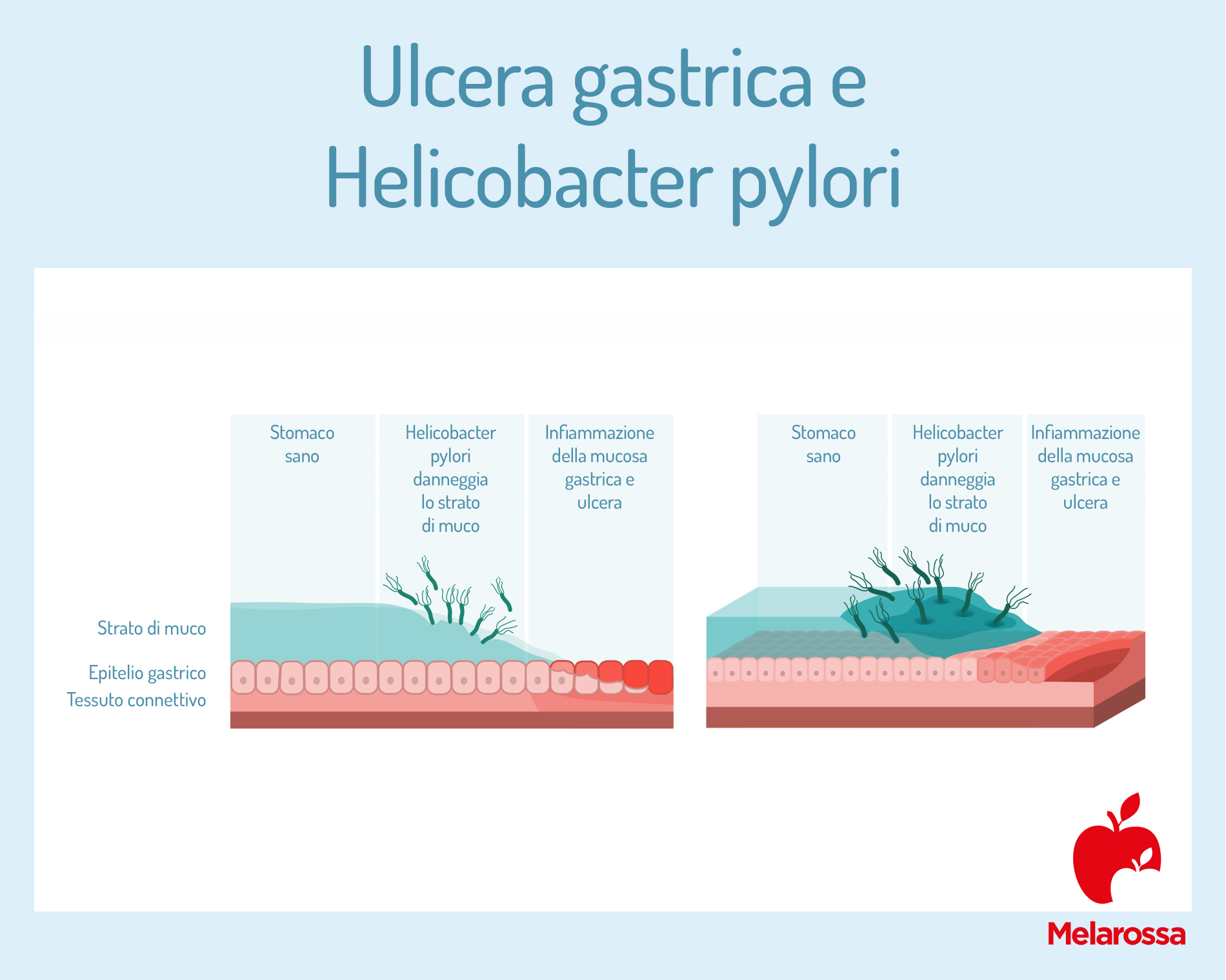 ulcera gastrica e helicobacter pylori