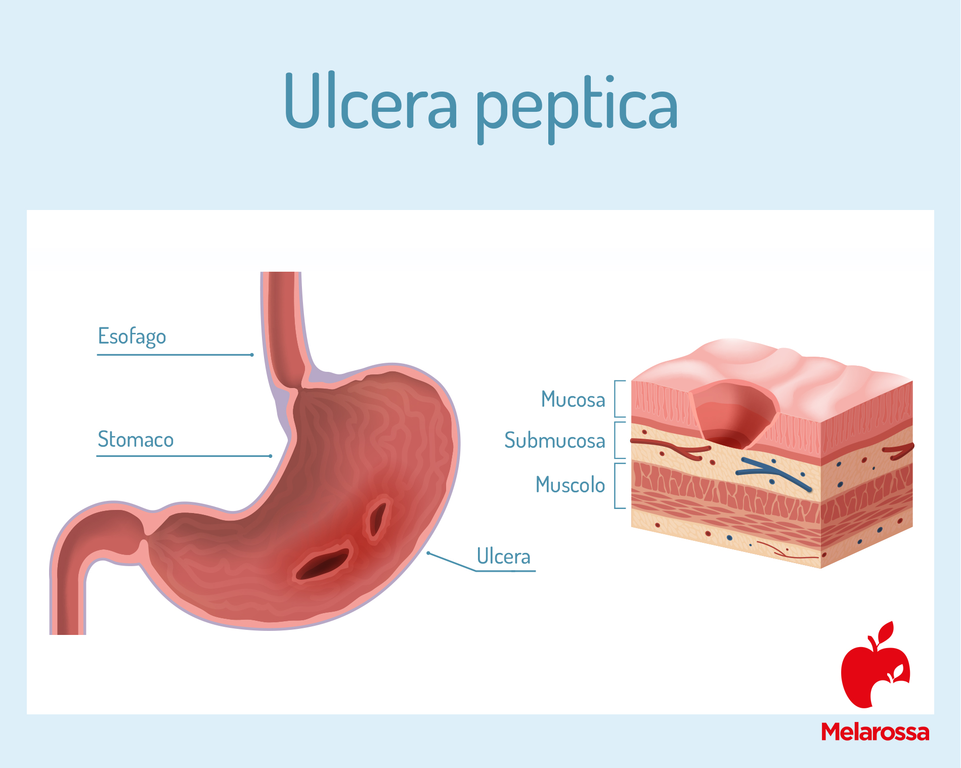ulcera peptica: cos'è