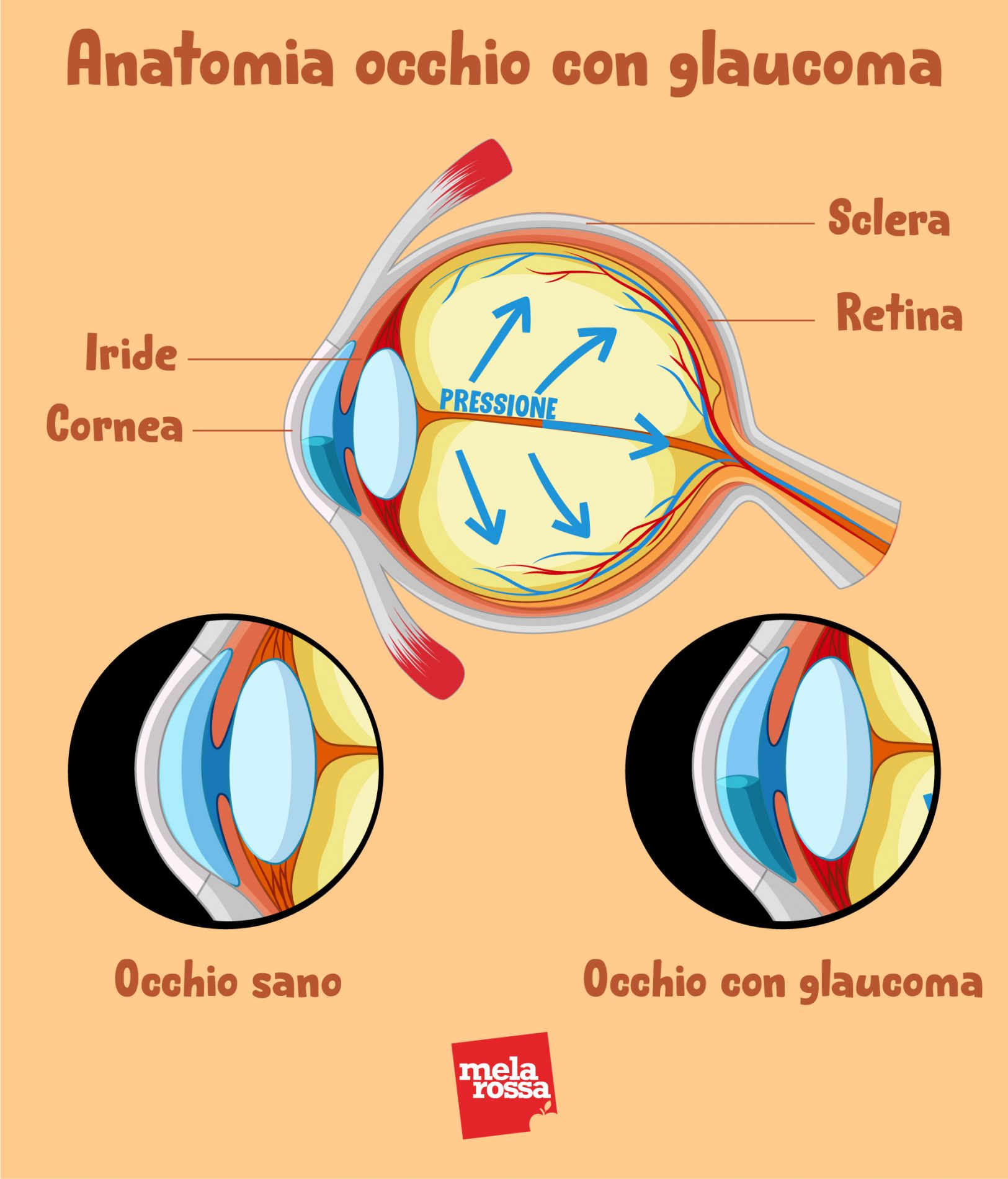 anatomia del glaucoma