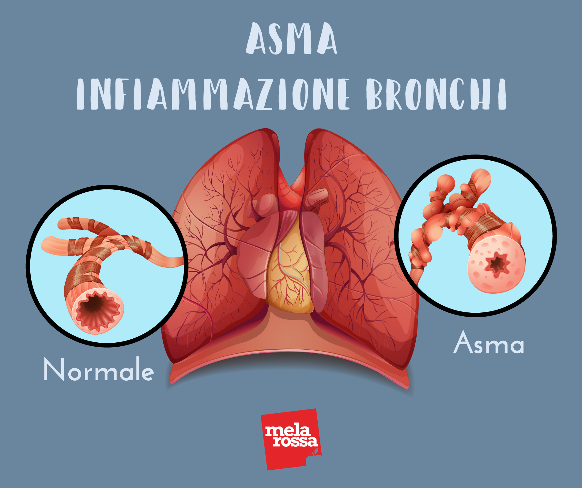 asma: infiammazione bronchi