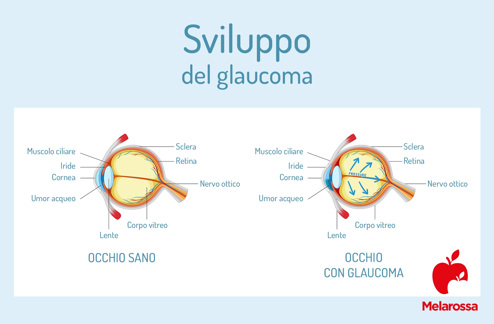 Glaucoma: sintomi, cura e prevenzione 3 Una grafica che illustra le diverse fasi del glaucoma