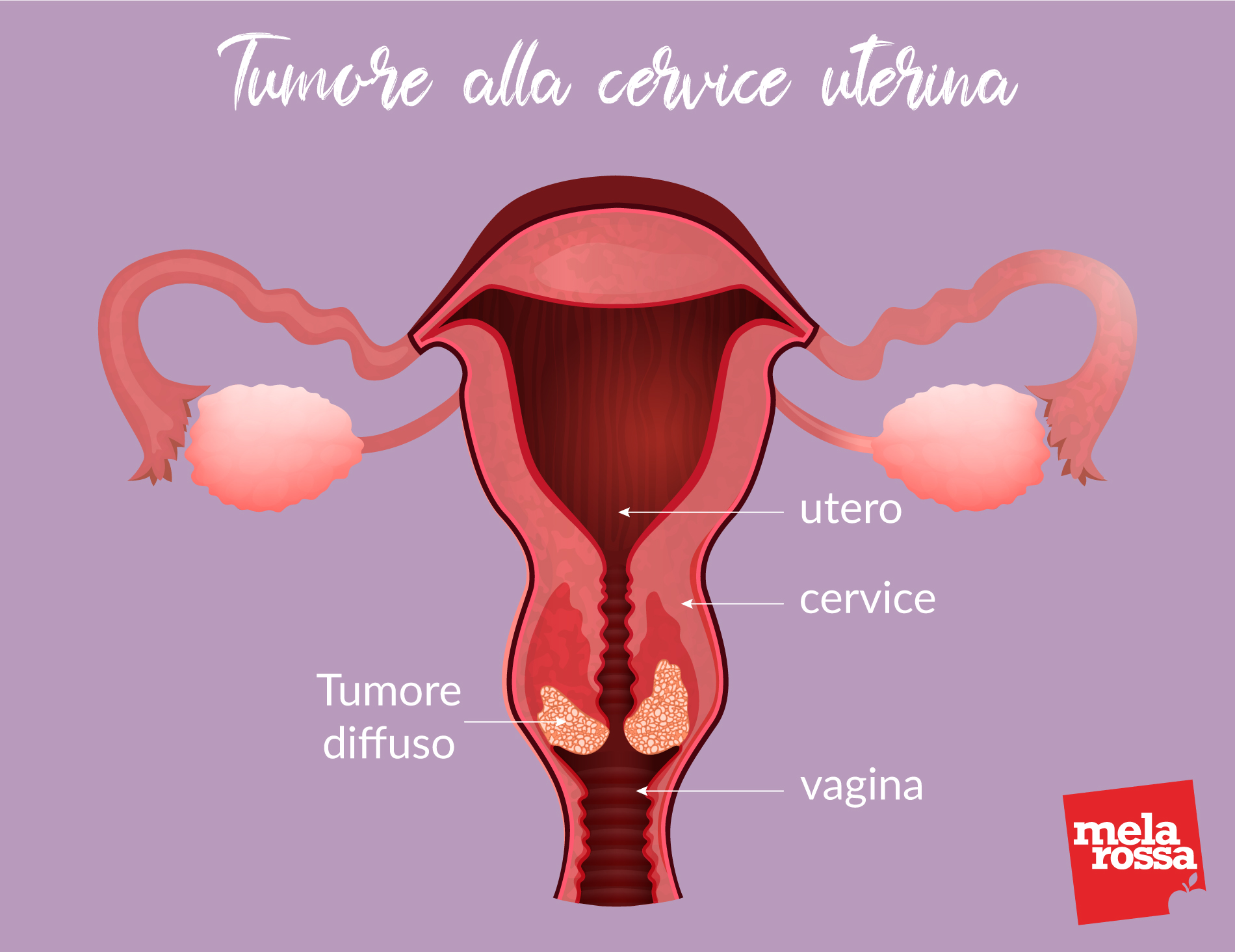 papa test per prevenire il tumore 