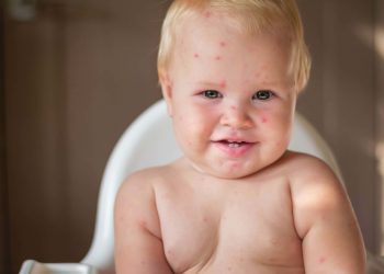 Un neonato affetto da herpes sul viso