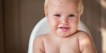 Un neonato affetto da herpes sul viso