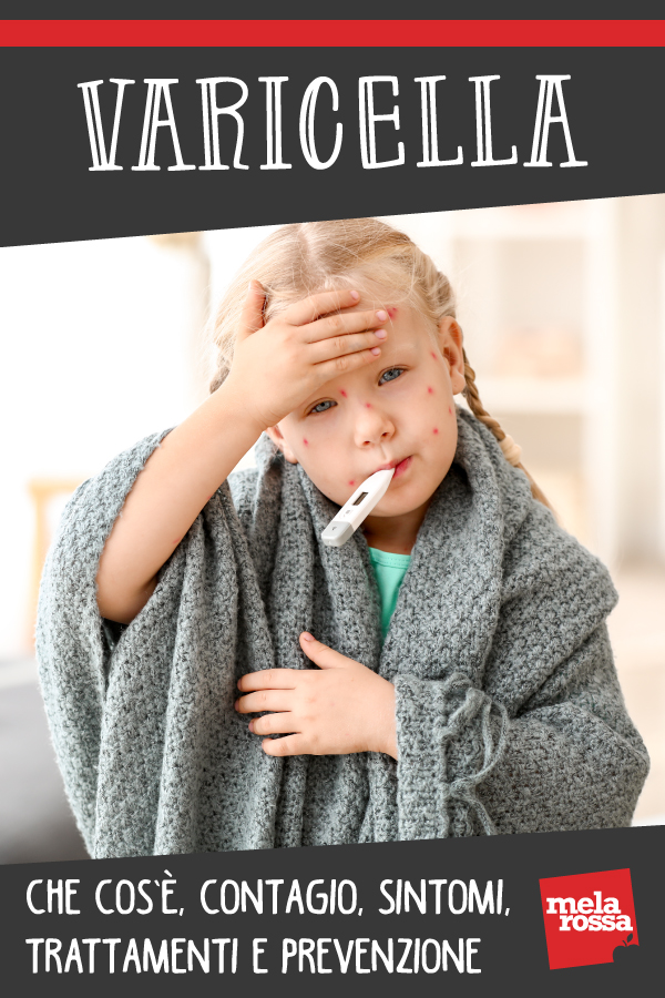 varicella: sintomi e trattamenti