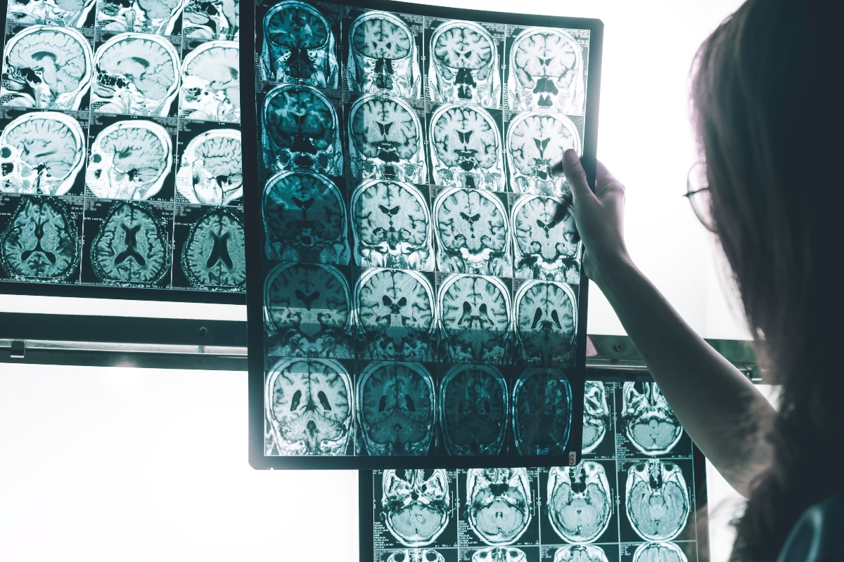 alzheimer diagnosi 1