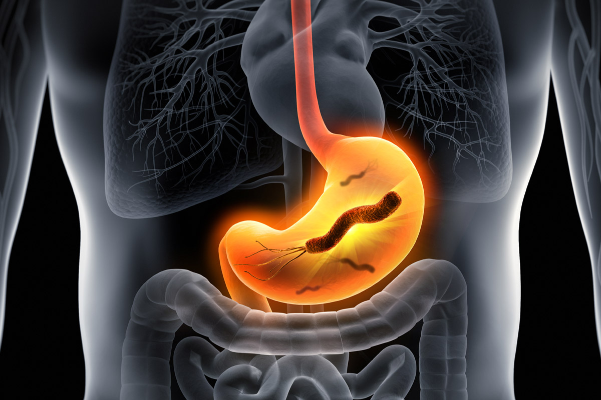 Helicobacter batterio stomaco