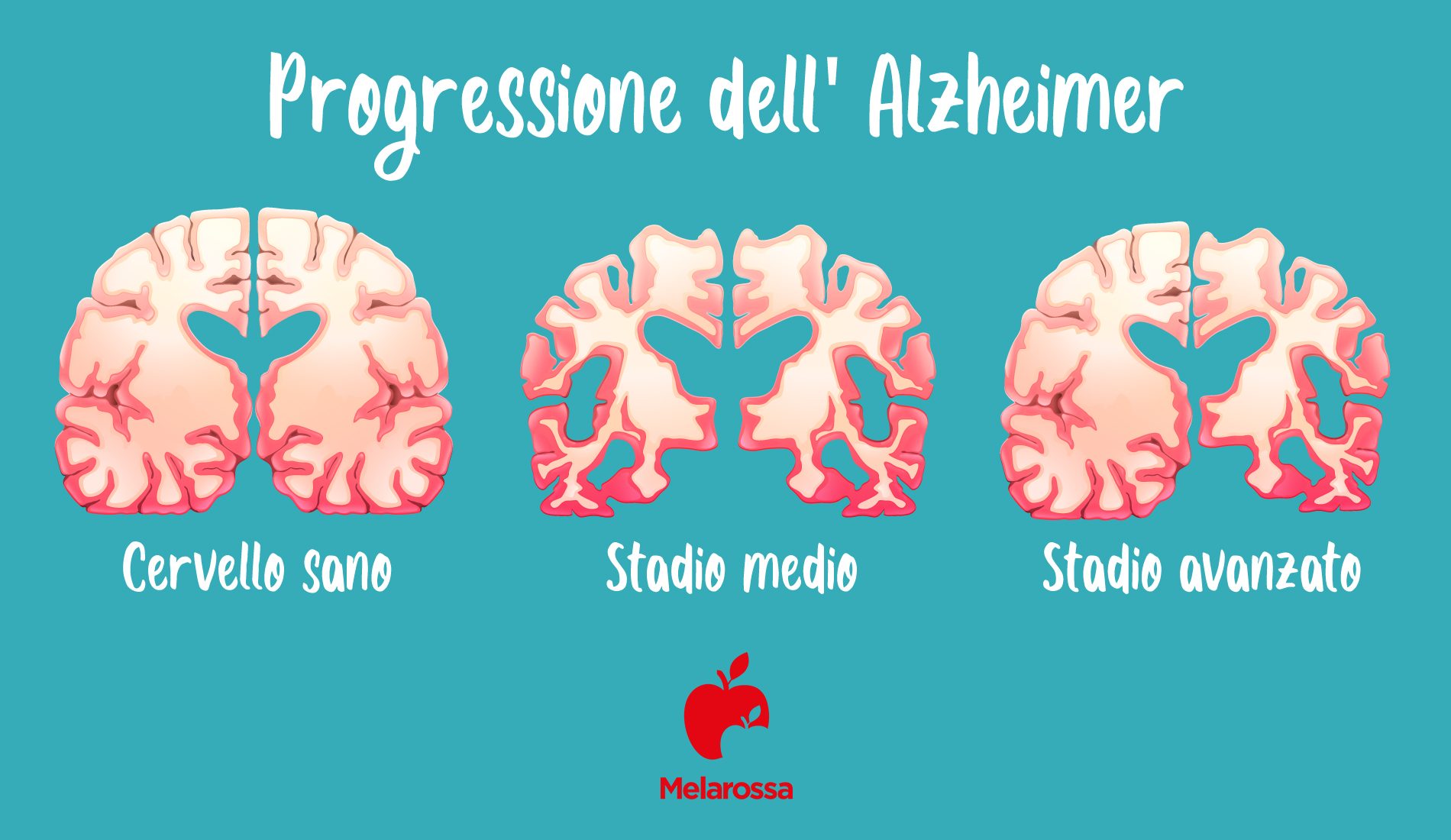 Progressione della malattia di Alzheimer