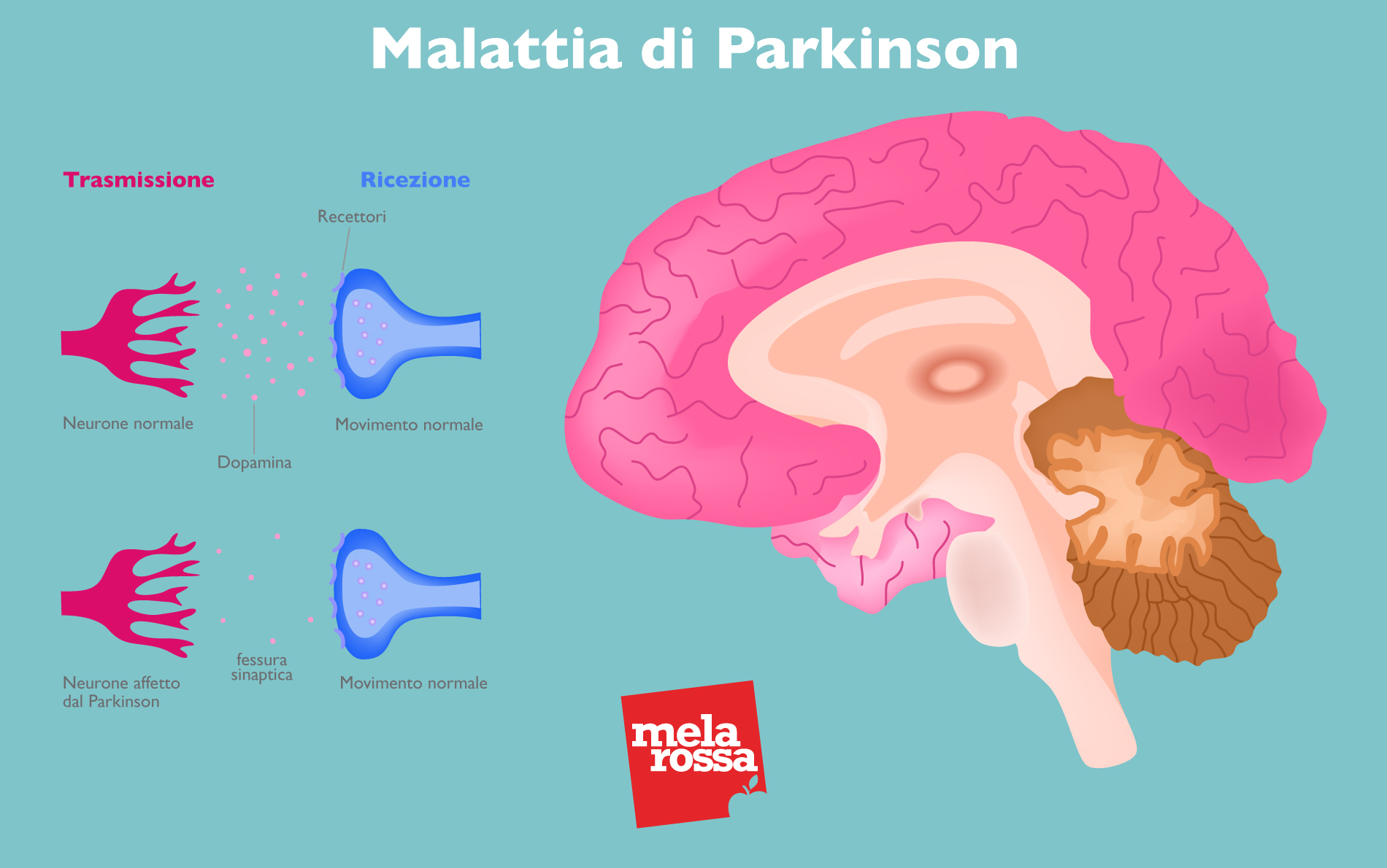 malattia di parkison: cervello