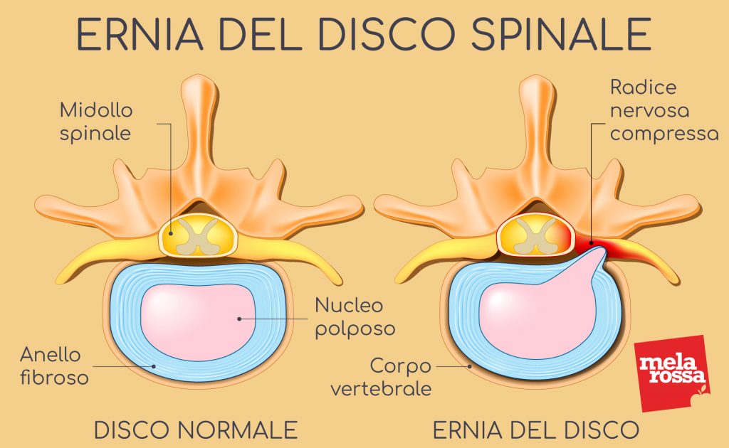 Ernia del disco che cos'è, cause, tipi, sintomi, diagnosi e prevenzione