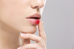 Cerotti, integratori e creme: i rimedi naturali e non per l’herpes labiale