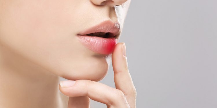 Cerotti, integratori, stick per le labbra: 8 alleati contro l'herpes labiale