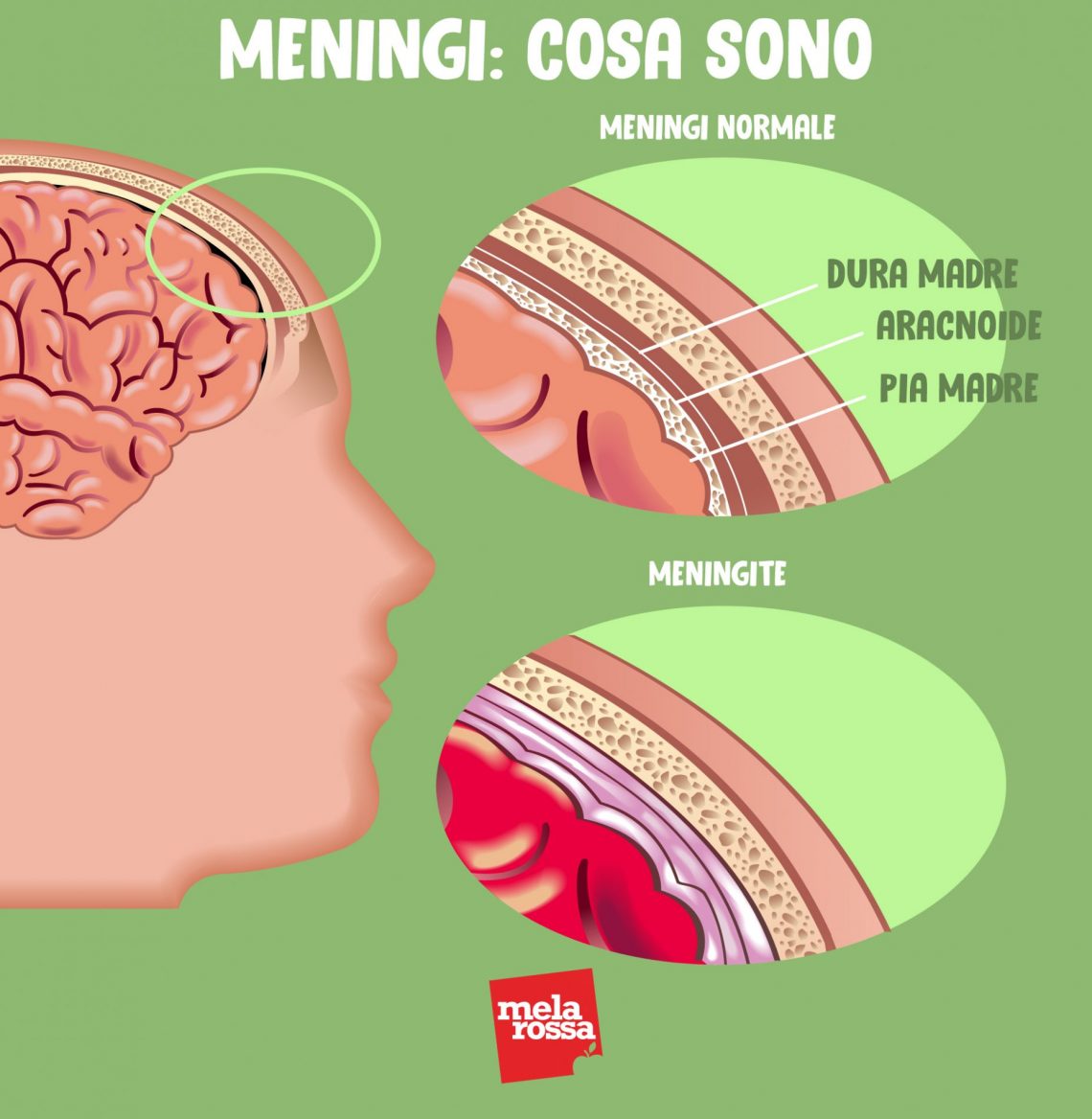 Meningite cos'è, cause, sintomi e trattamenti Melarossa