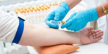 Tumore del colon retto: un test del sangue per la diagnosi precoce