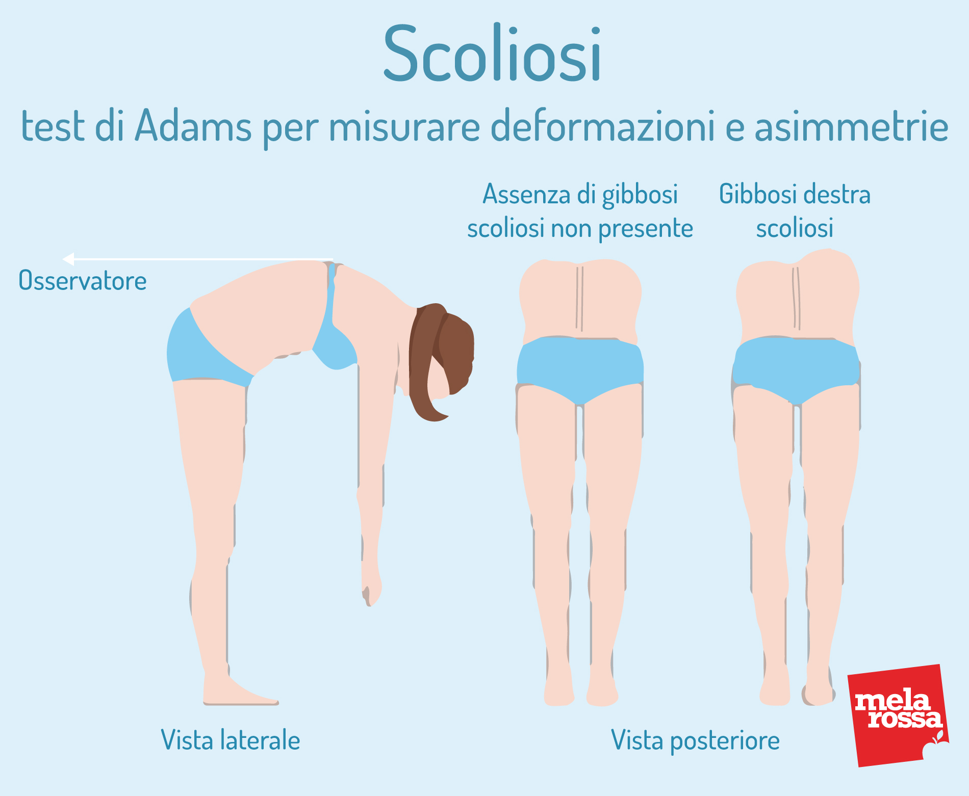 Scoliosi: test di Adams per misurare deformzioni