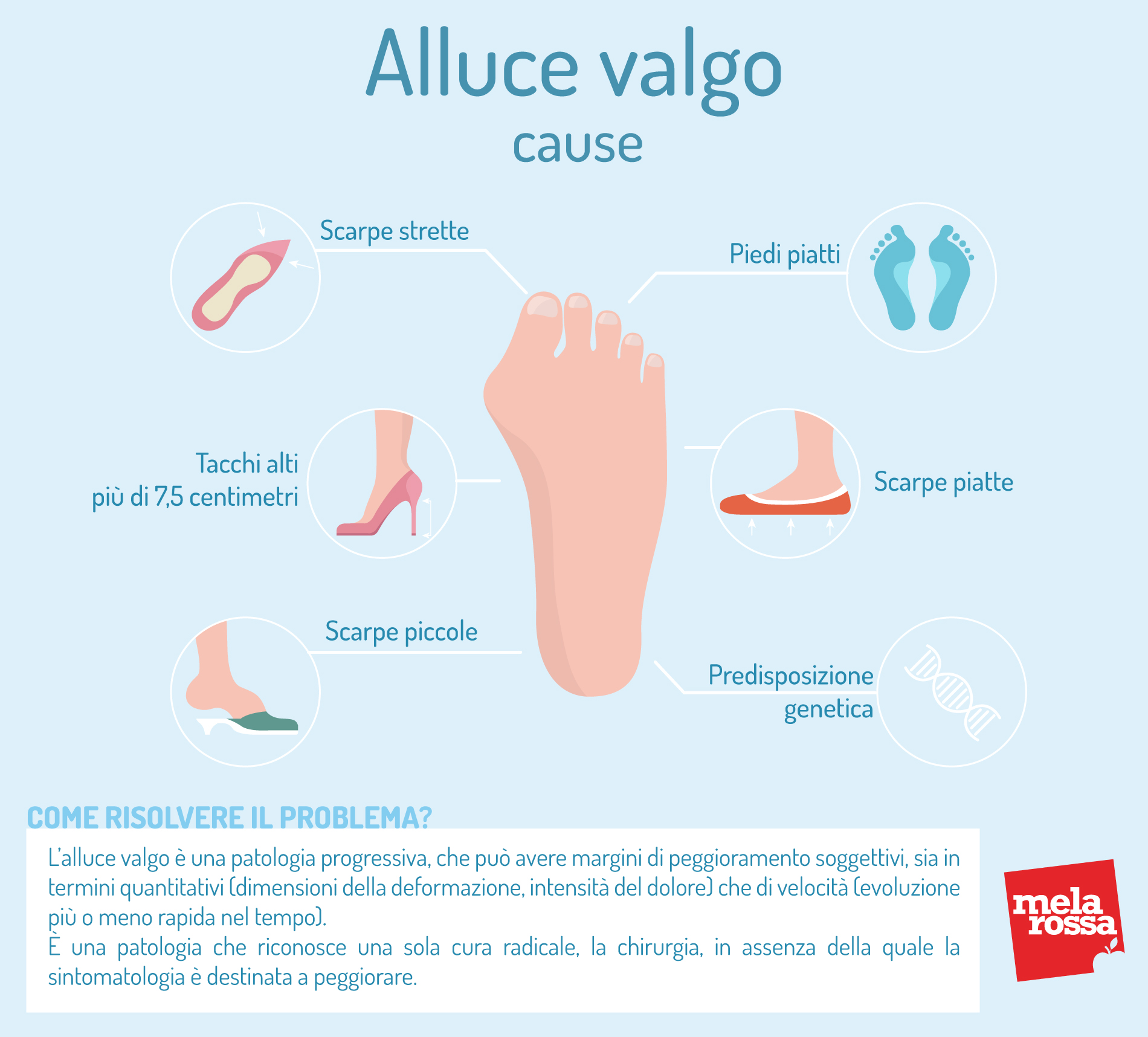 Alluce valgo: cause