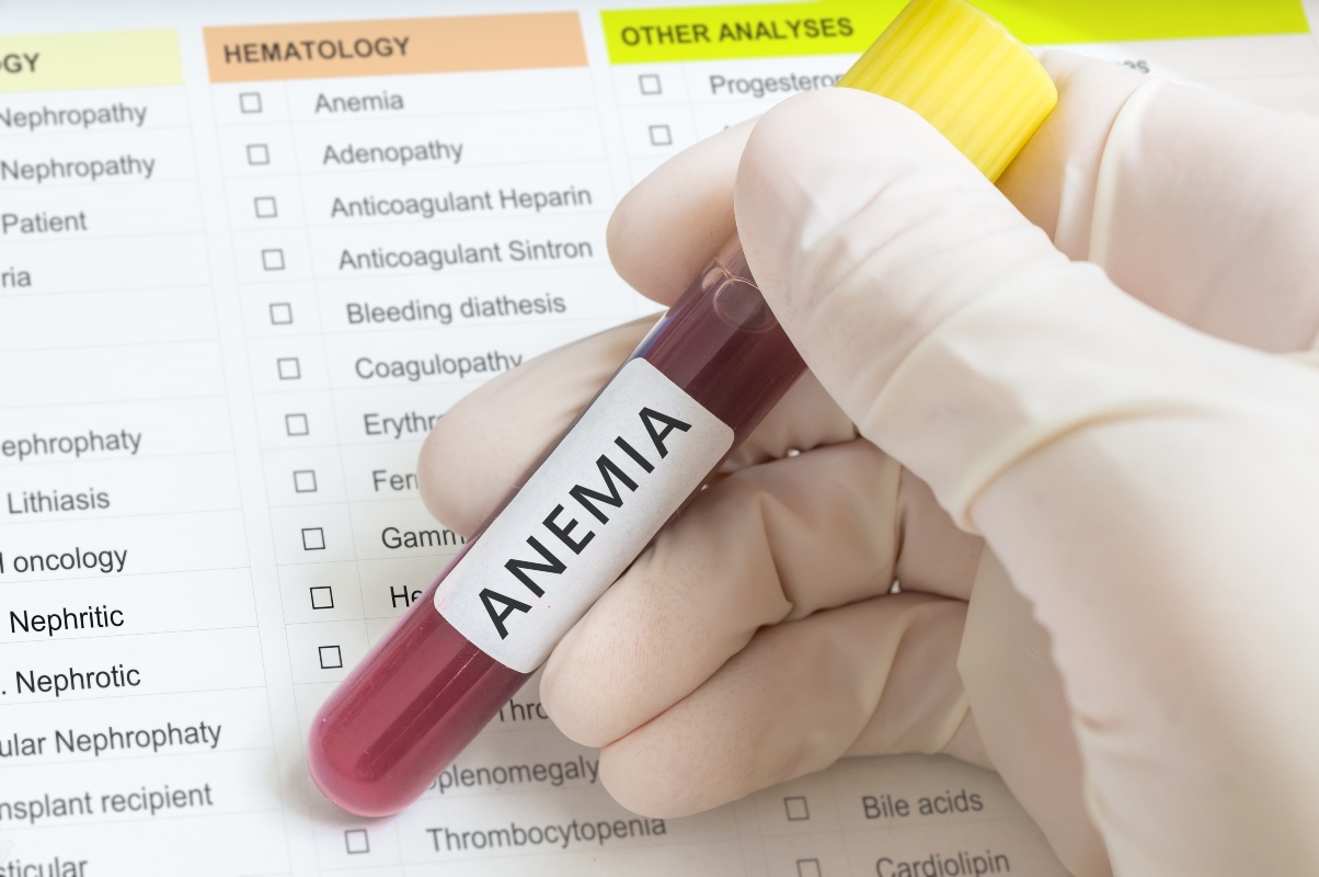 anemia: epidemiologia