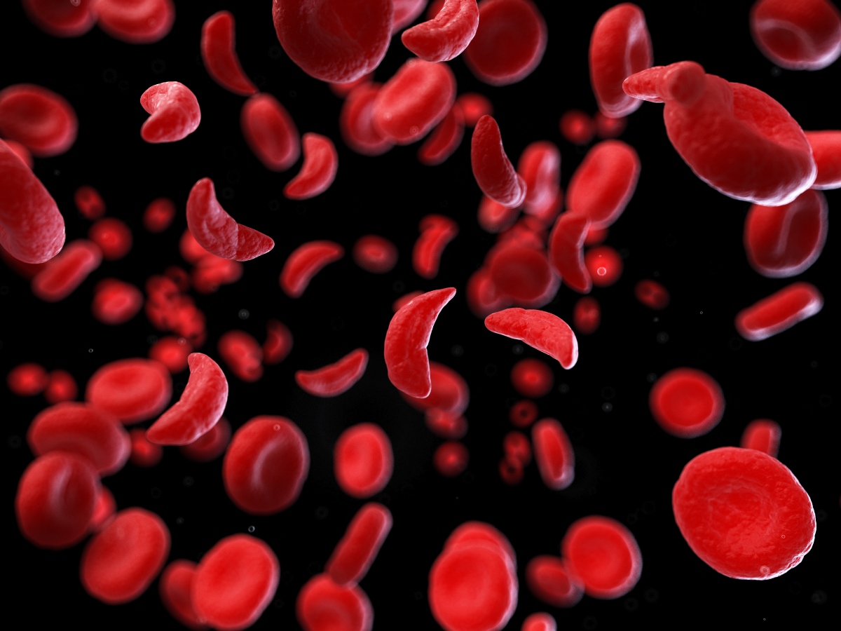 anemia e globuli rossi