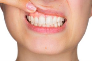 Parodontite: chi ha il diabete rischia di più